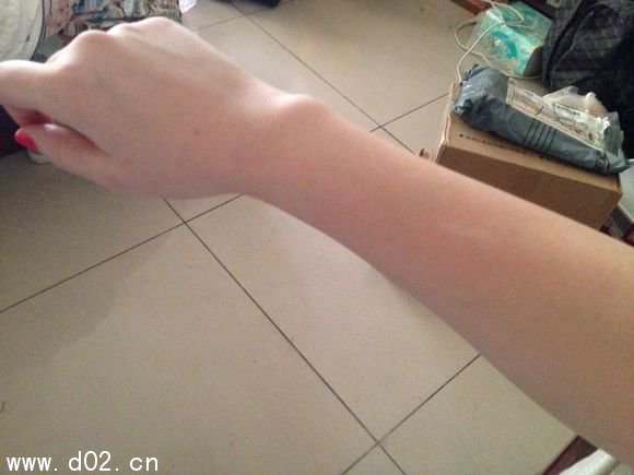 白色胎记好不好?